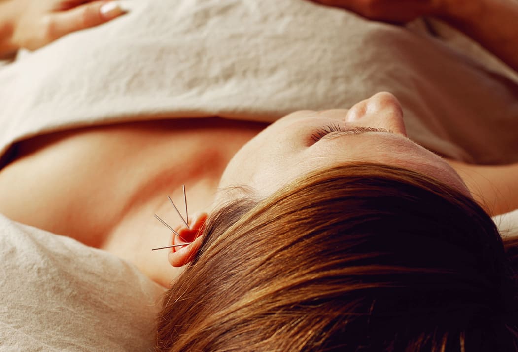 Acupuncture
